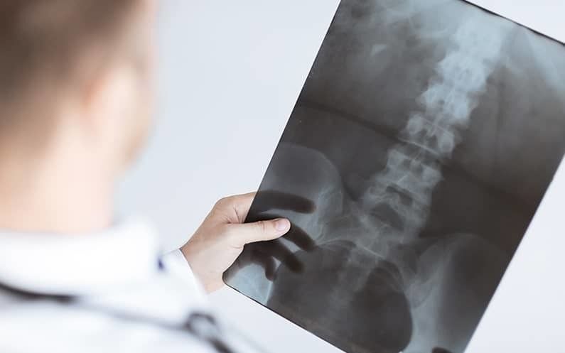 What does an incomplete spinal injury mean to my life?