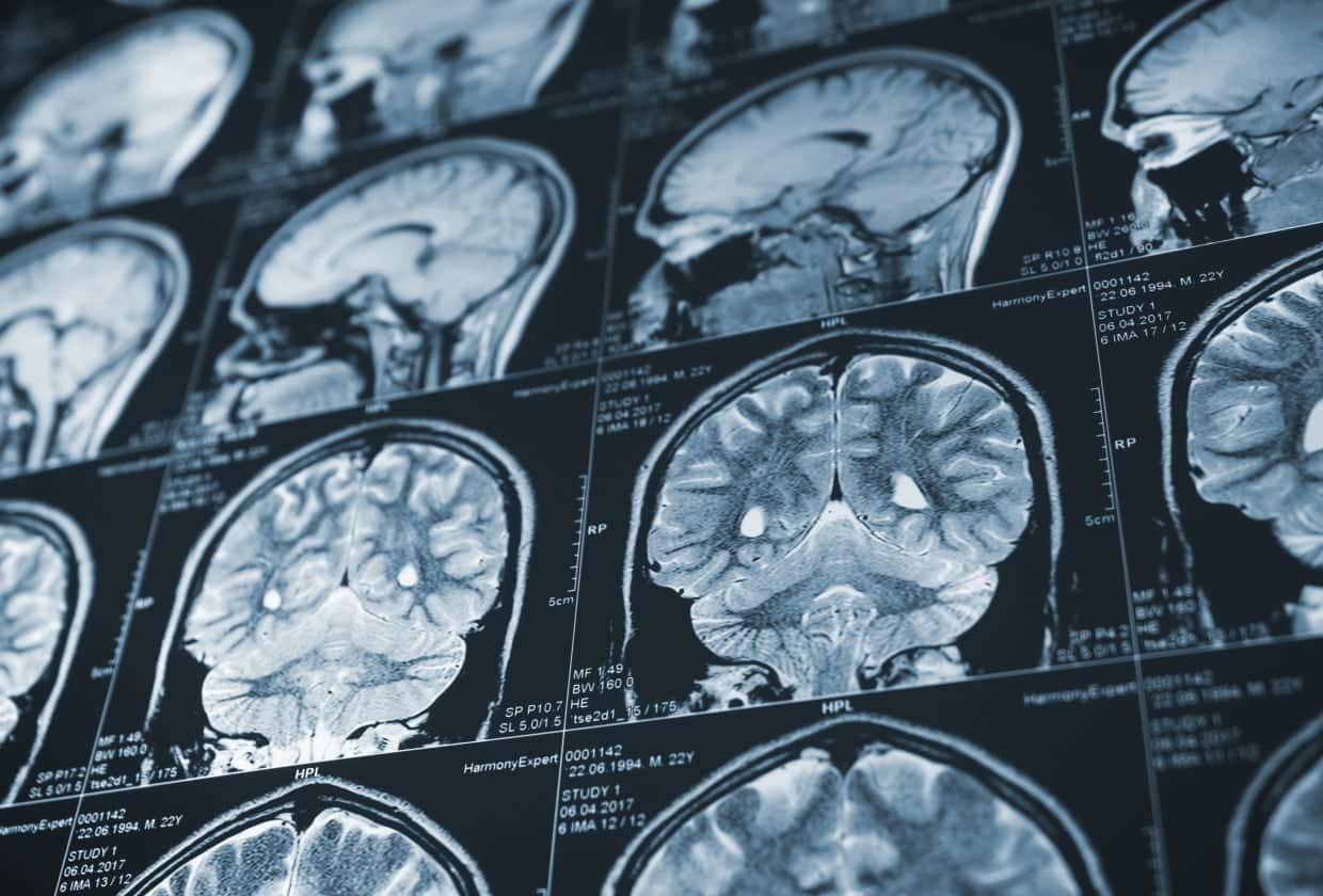 Traumatic Brain Injury