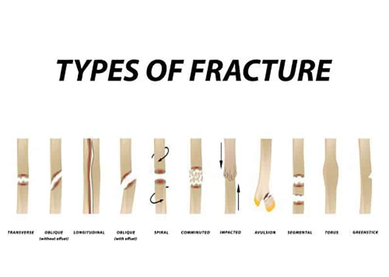 Types of broken bones